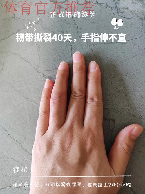 Siegel：康查尔左手拇指尺侧副韧带撕裂，三周后复查